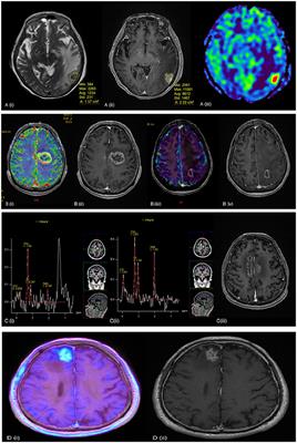 Diagnosis and Management of Radiation Necrosis in Patients With Brain Metastases